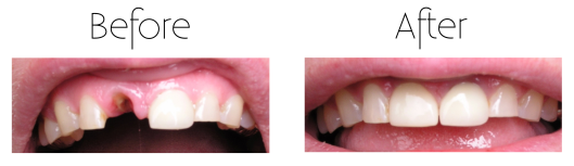 Root Canal Treatment (Endodontic Therapy) Before After